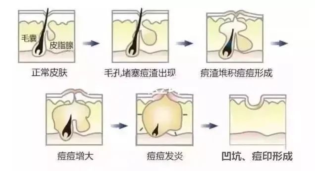 如何祛除痘坑？祛除痘坑最好的方法