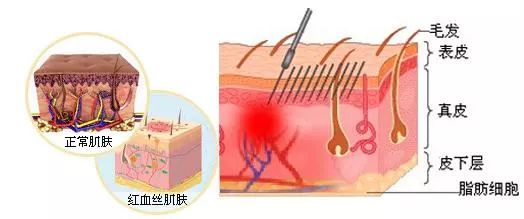 紅血絲是什么原因導致的