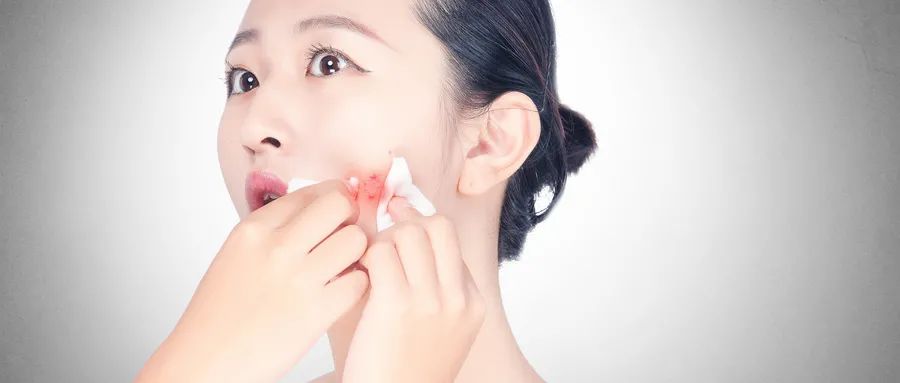 如何預(yù)防粉刺的發(fā)生和痤瘡的形成？