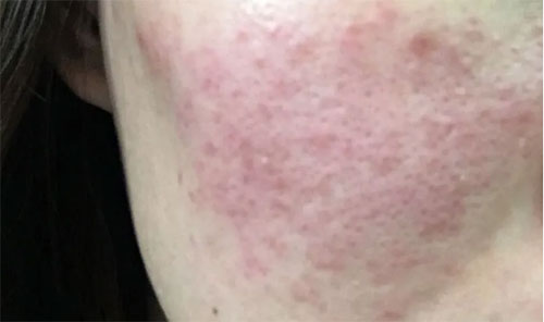 皮膚泛紅癢是什么原因？皮膚紅癢怎么回事？