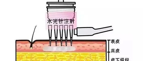 水光針的類型有哪幾種？
