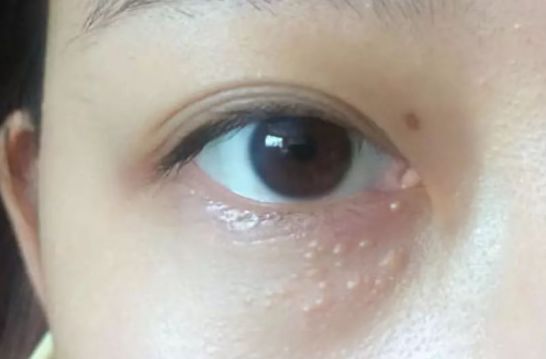為什么眼部容易長脂肪粒？