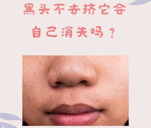 什么是黑頭？怎樣預(yù)防黑頭的形成？